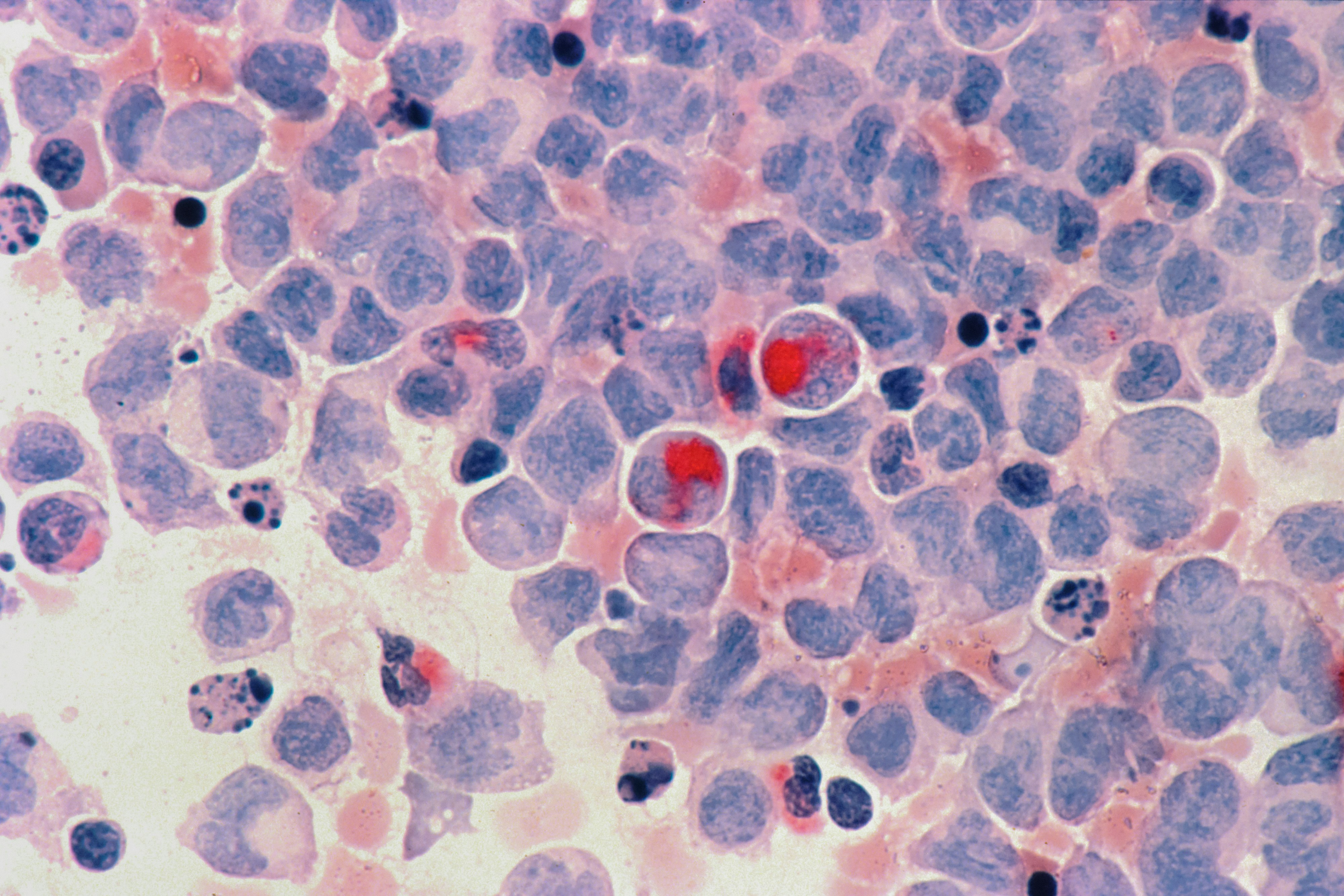 Cancer Cachexia Recast as Neuro-Metabolic Disorder