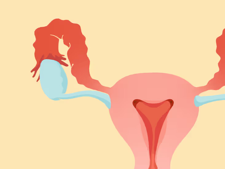Pelvic Inflammatory Disease