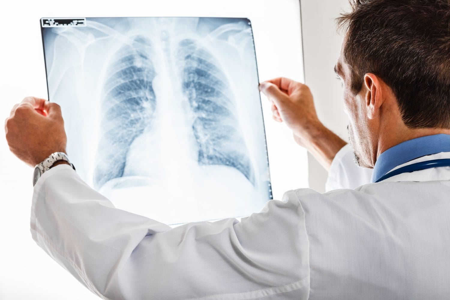 14-Protein Blood Plasma Signature Predicts Lung Cancer Years Before Scans