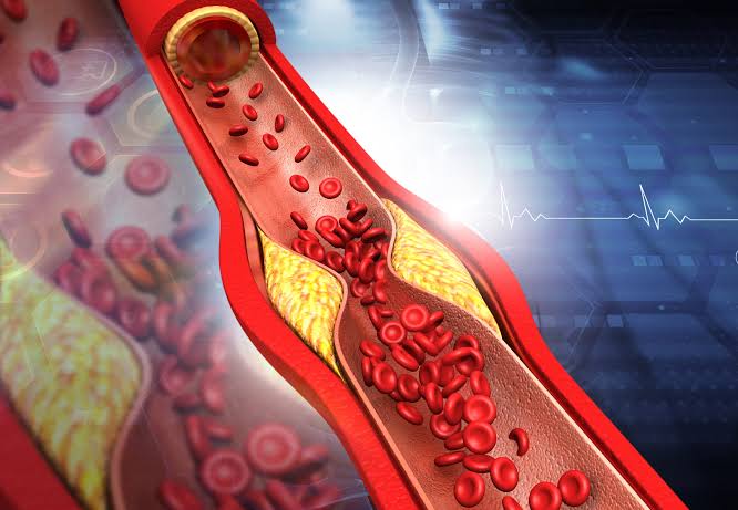 Study links atherosclerosis to autoimmune disease criteria